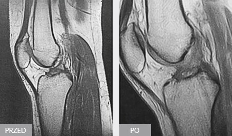Terapia ENF po urazie ACL