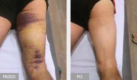 Terapia ENF uszkodzenia mięśnia ścięgna podkolanowego z obecnością rozległego nieregularnego gromadzenia się płynu i krwiakiem śródmięśniowym w fazie organizacyjnej