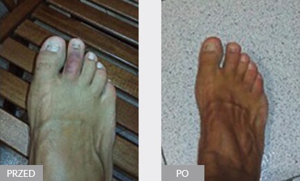 Terapia ENF krwiaka drugiego palca